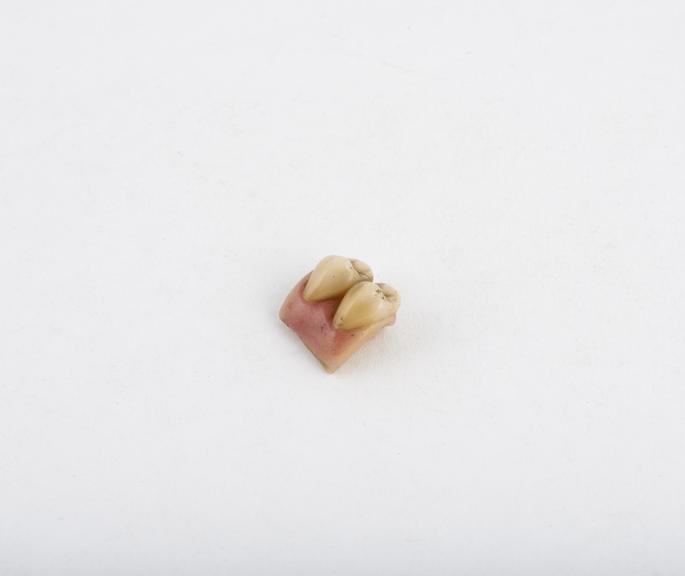 False tooth, block of 2 posterior gum section teeth