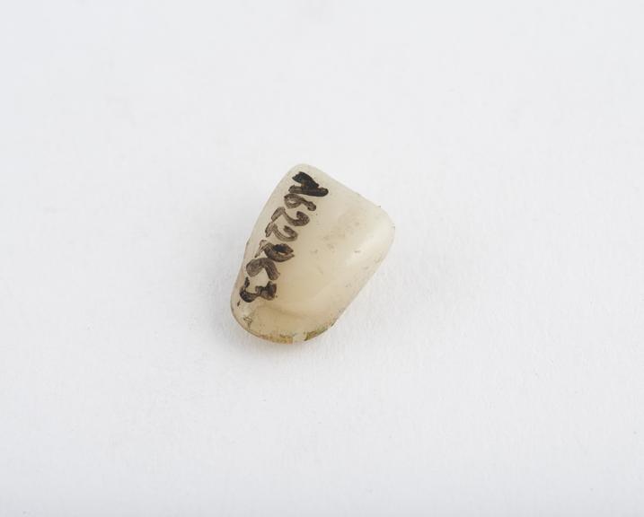 False tooth, upper central incisor, pinned, porcelain, English