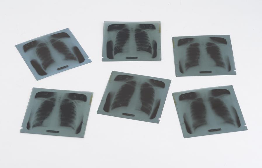 Nineteen separate 100mm miniature x-ray films