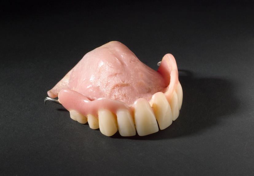 Partial upper denture, acrylic with alloy clasps, Enligsh