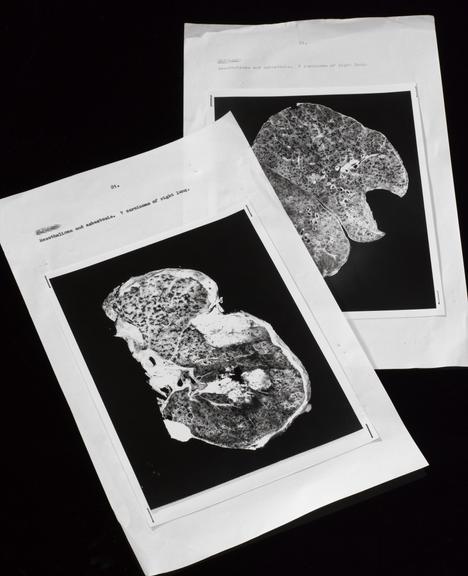 Post Mortem Reports Investigating Cases of Mesothelioma, 1958-1976
