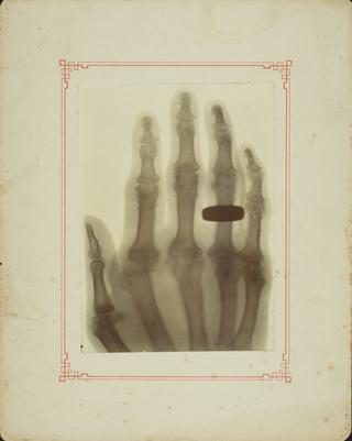 X-ray photography of a woman's hand, Manchester, England, 1896