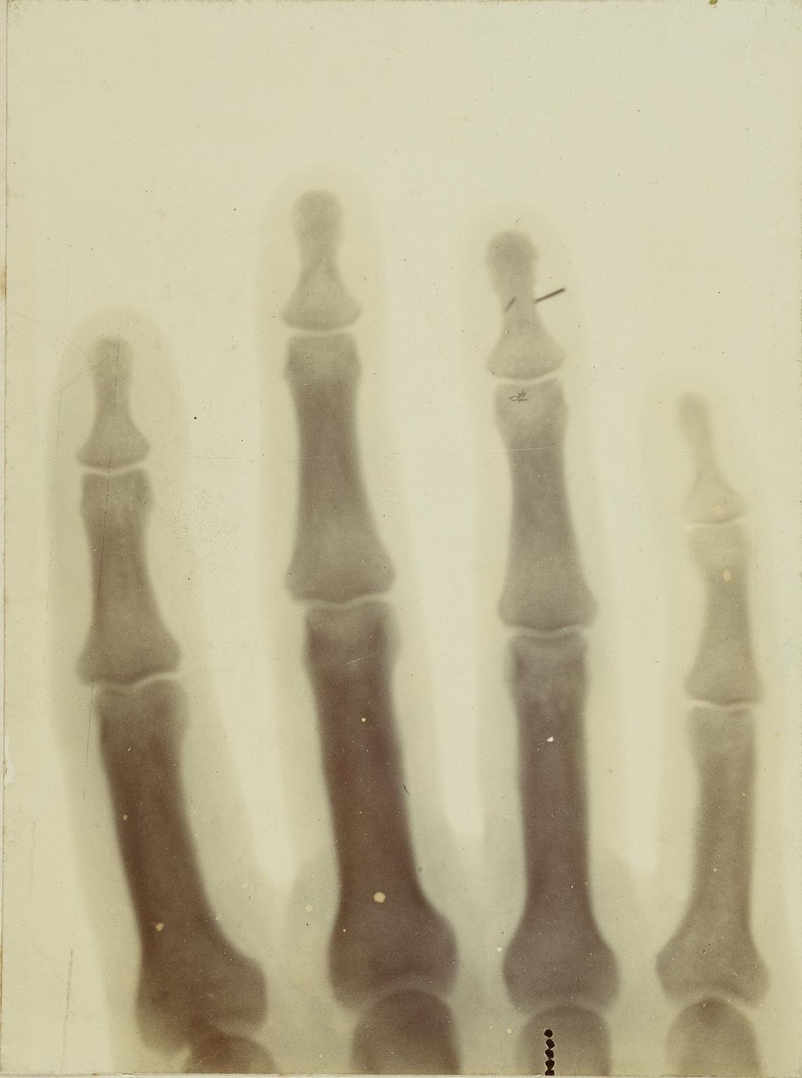 x-ray photograph. [a broken needle in an index finger bone] / by Prof. Arthur Schuster