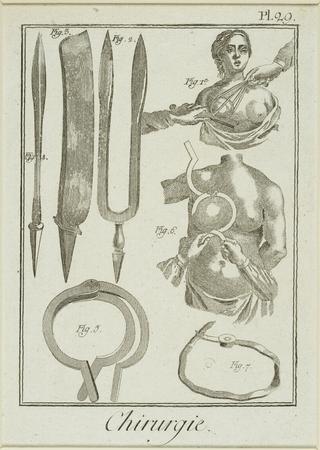 Heister's method for the removal of tumour from a breast, France, 1780