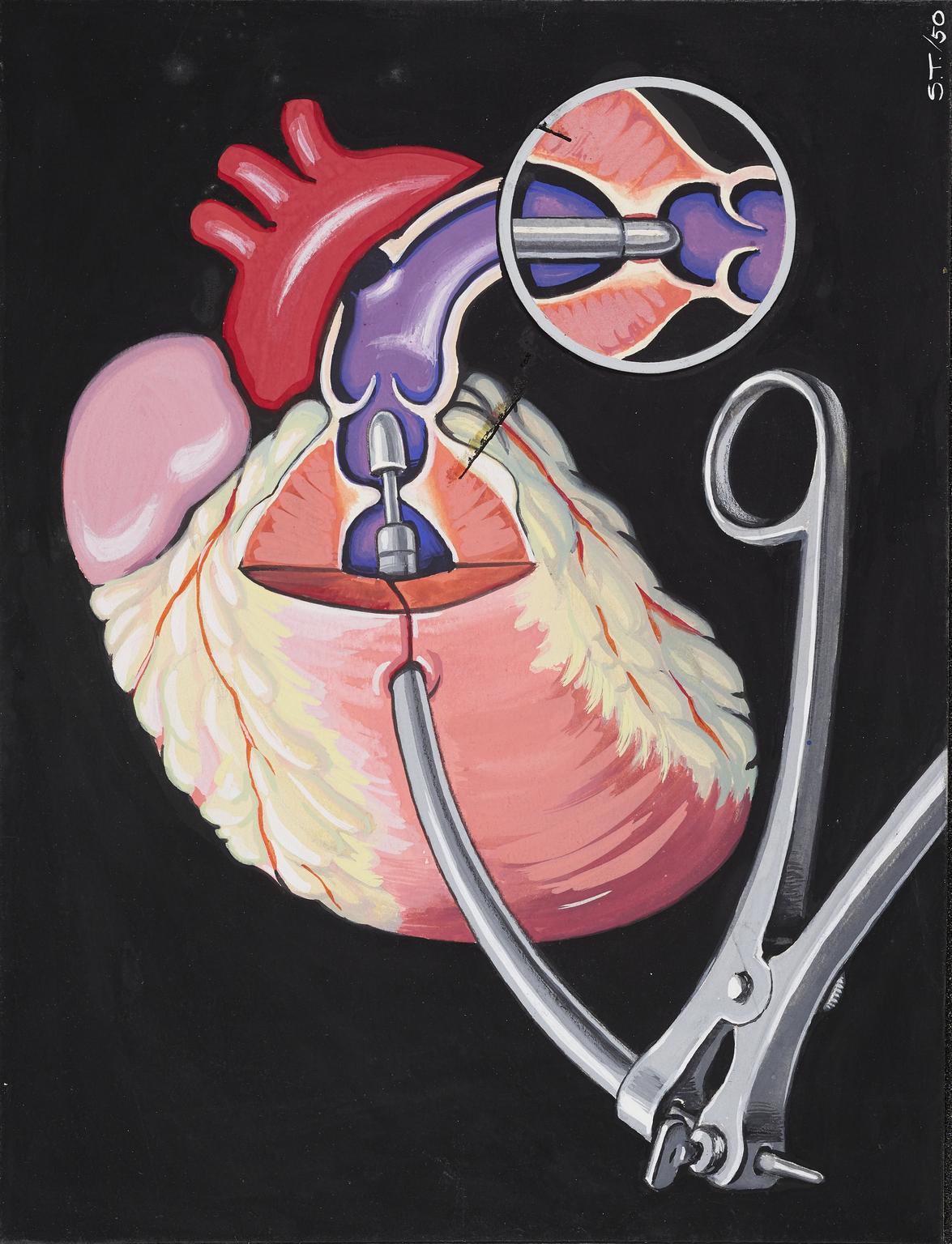 Diagram of an Infundibular Resector in use, 1950