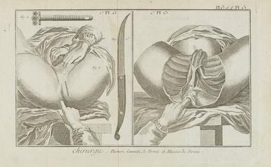 Print, engraving. Plate 13 'Chirurgie'