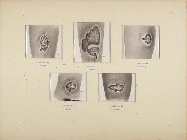 drawing, ulcertive conditions