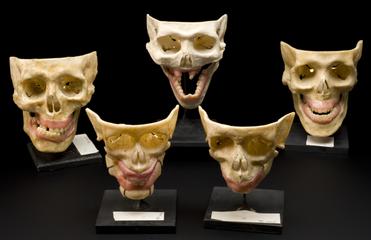 Dentist's models of child's skull needing bone grafts