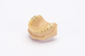Demonstration lower denture showing two amalgam fillings and two "Occlusin" fillings